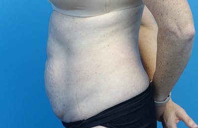 Abdominoplasty Before & After Gallery - Patient 424577 - Image 1