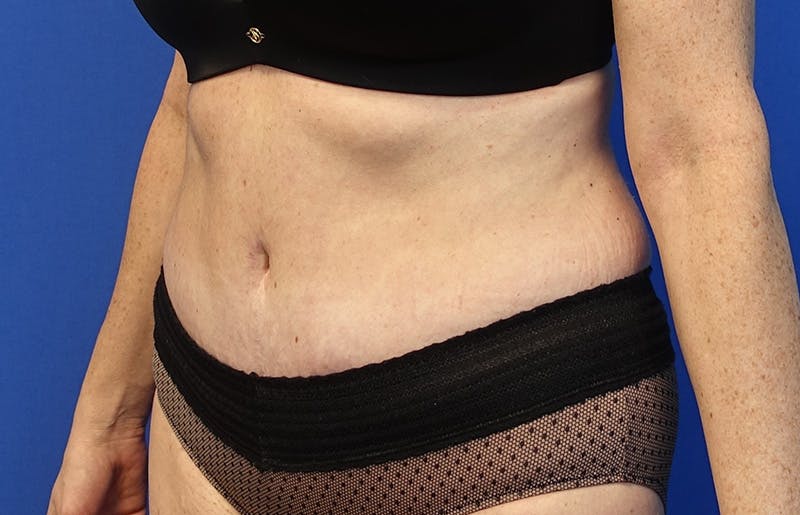 Abdominoplasty Before & After Gallery - Patient 424577 - Image 4