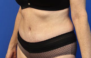 Abdominoplasty Before & After Gallery - Patient 424577 - Image 4