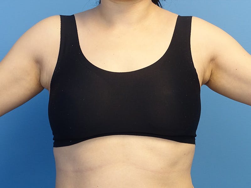 Axillary Breast Removal Before & After Gallery - Patient 147843 - Image 1