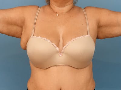 Axillary Breast Removal Before & After Gallery - Patient 133104 - Image 1