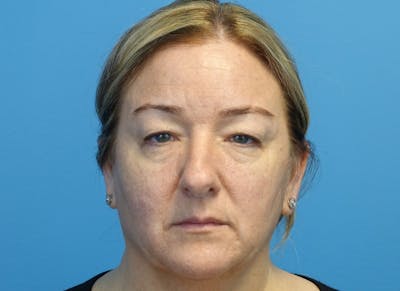 Blepharoplasty Before & After Gallery - Patient 336807 - Image 1