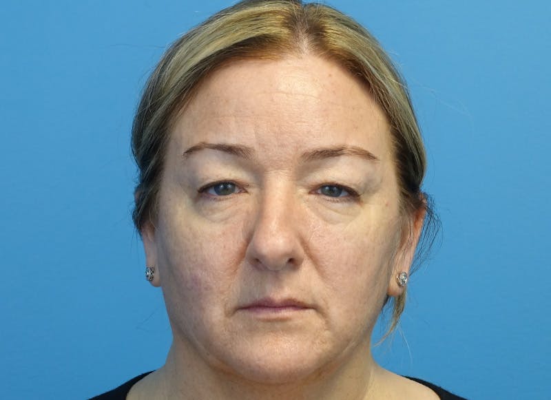 Blepharoplasty Before & After Gallery - Patient 336807 - Image 1