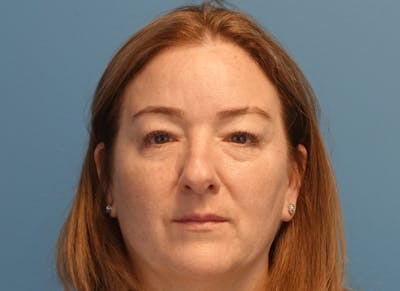 Blepharoplasty Before & After Gallery - Patient 336807 - Image 2
