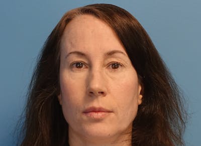 Blepharoplasty Before & After Gallery - Patient 335687 - Image 1