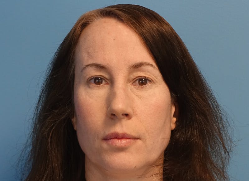 Blepharoplasty Before & After Gallery - Patient 335687 - Image 1