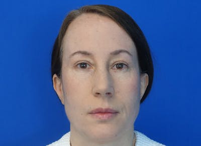 Blepharoplasty Before & After Gallery - Patient 335687 - Image 2
