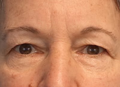 Blepharoplasty Before & After Gallery - Patient 289322 - Image 1