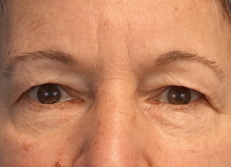 Blepharoplasty Before & After Gallery - Patient 289322 - Image 1
