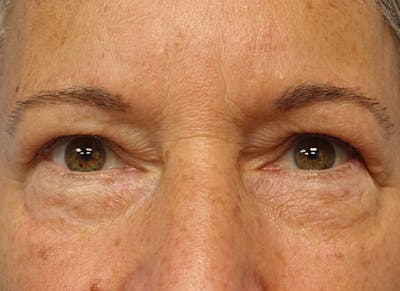 Blepharoplasty Before & After Gallery - Patient 289322 - Image 2