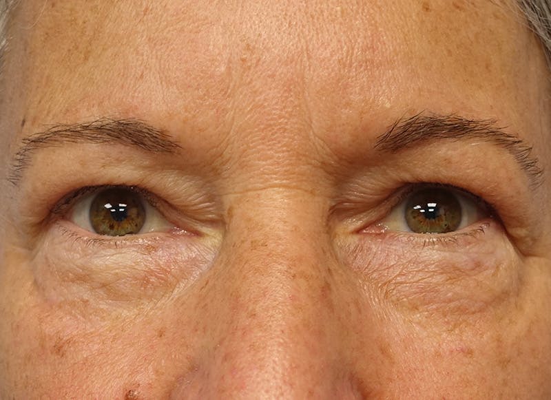 Blepharoplasty Before & After Gallery - Patient 289322 - Image 2