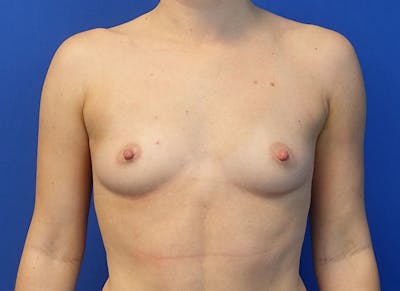Augmentation Before & After Gallery - Patient 292453 - Image 5