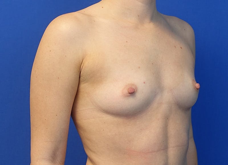 Augmentation Before & After Gallery - Patient 292453 - Image 7