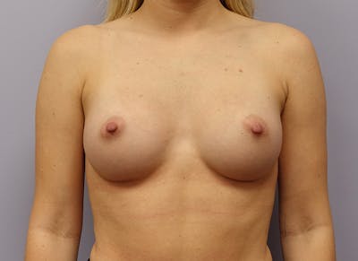 Augmentation Before & After Gallery - Patient 292453 - Image 6