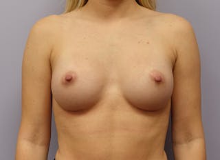Augmentation Before & After Gallery - Patient 292453 - Image 6
