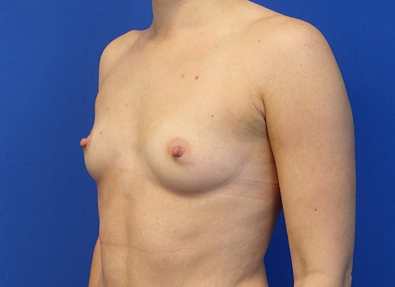 Augmentation Before & After Gallery - Patient 292453 - Image 3