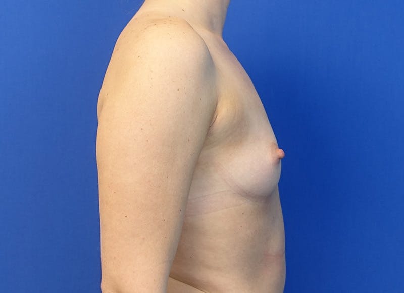 Augmentation Before & After Gallery - Patient 292453 - Image 9