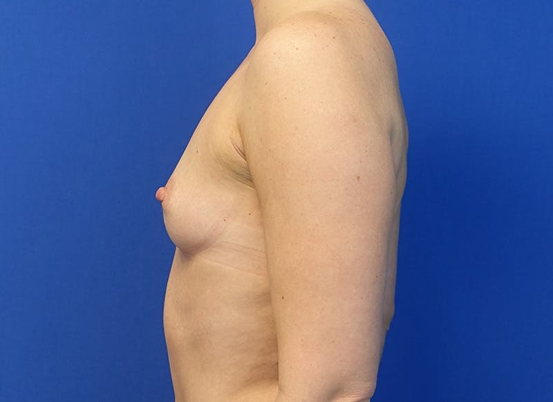 Augmentation Before & After Gallery - Patient 292453 - Image 1