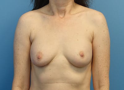 Implant Removal Before & After Gallery - Patient 905888 - Image 5