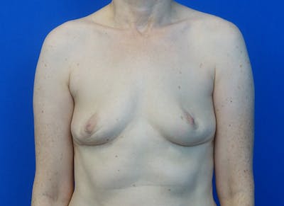 Implant Removal Before & After Gallery - Patient 905888 - Image 6