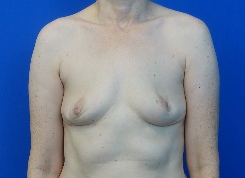 Implant Removal Before & After Gallery - Patient 905888 - Image 6