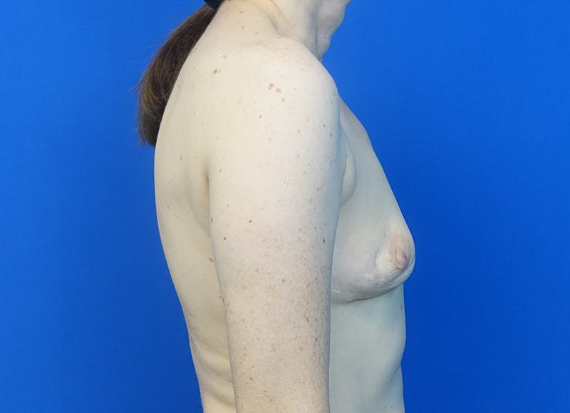 Implant Removal Before & After Gallery - Patient 905888 - Image 10