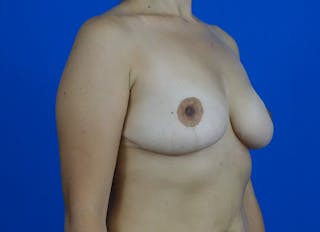 Breast Reduction Before & After Gallery - Patient 268915 - Image 8