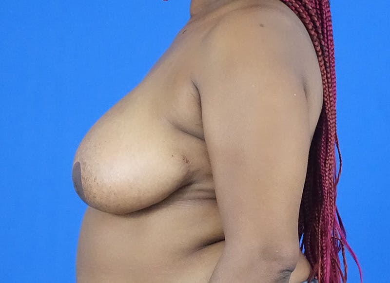 Breast Reduction Before & After Gallery - Patient 304452 - Image 2