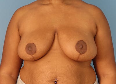 Breast Reduction Before & After Gallery - Patient 712088 - Image 6