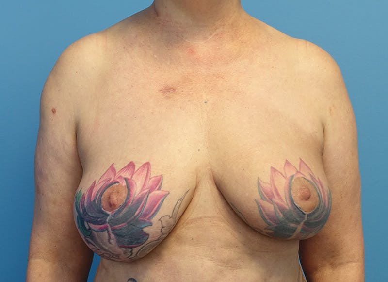 Breast Reduction Before & After Gallery - Patient 405143 - Image 5