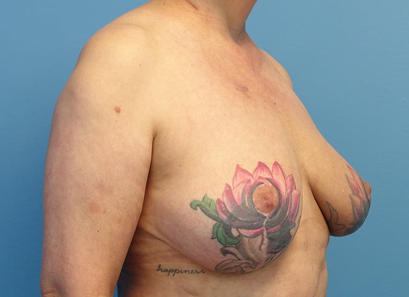 Breast Reduction Before & After Gallery - Patient 405143 - Image 7