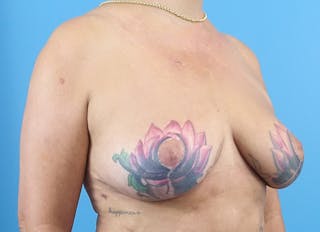 Breast Reduction Before & After Gallery - Patient 405143 - Image 8
