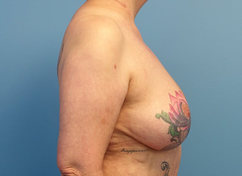 Breast Reduction Before & After Gallery - Patient 405143 - Image 9
