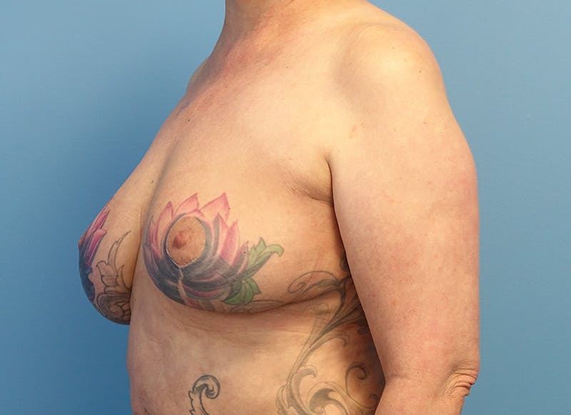 Breast Reduction Before & After Gallery - Patient 405143 - Image 3