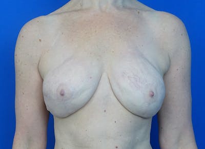 Flap Reconstruction Gallery Before & After Gallery - Patient 186181 - Image 6