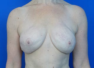 Flap Reconstruction Gallery Before & After Gallery - Patient 186181 - Image 6