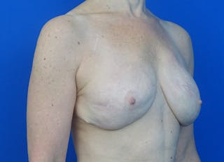 Flap Reconstruction Gallery Before & After Gallery - Patient 186181 - Image 8