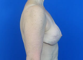 Flap Reconstruction Gallery Before & After Gallery - Patient 186181 - Image 10