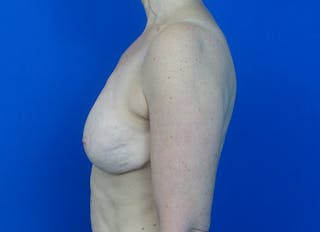 Flap Reconstruction Gallery Before & After Gallery - Patient 186181 - Image 2
