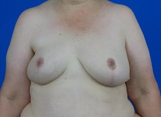Flap Reconstruction Gallery Before & After Gallery - Patient 378789 - Image 6