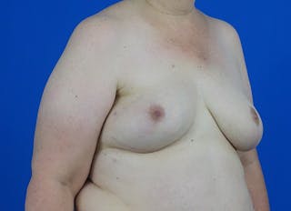 Flap Reconstruction Gallery Before & After Gallery - Patient 378789 - Image 8