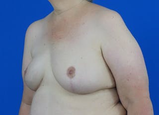 Flap Reconstruction Gallery Before & After Gallery - Patient 378789 - Image 4