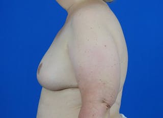 Flap Reconstruction Gallery Before & After Gallery - Patient 378789 - Image 2