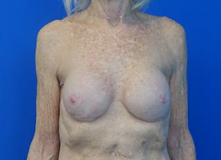 Implant Reconstruction Gallery Before & After Gallery - Patient 401657 - Image 6