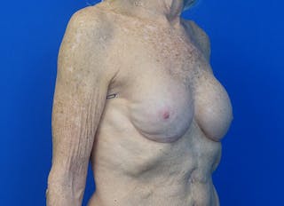 Implant Reconstruction Gallery Before & After Gallery - Patient 401657 - Image 8