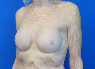 Implant Reconstruction Gallery Before & After Gallery - Patient 401657 - Image 4