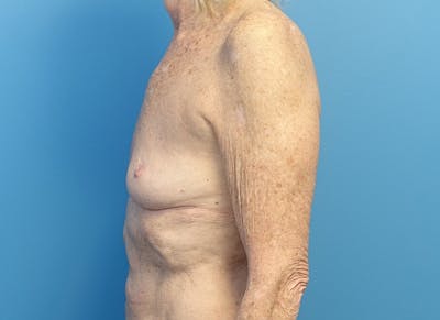 Implant Reconstruction Gallery Before & After Gallery - Patient 401657 - Image 1