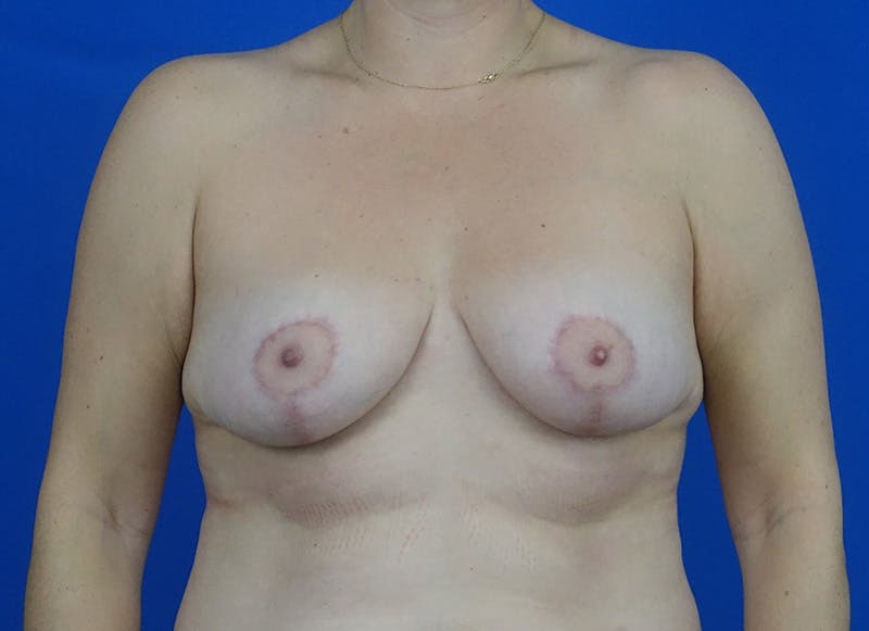 Breast Lift Before & After Gallery - Patient 400773 - Image 6
