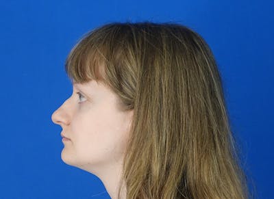 Rhinoplasty Before & After Gallery - Patient 750426 - Image 1