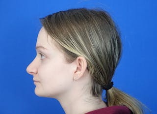 Rhinoplasty Before & After Gallery - Patient 750426 - Image 2